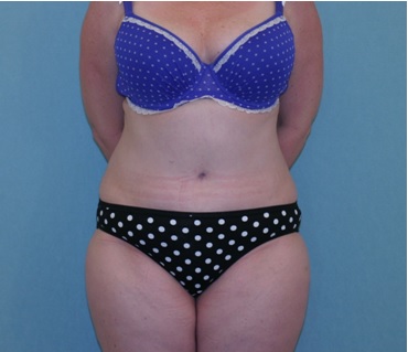 Abdominoplasty (Tummy Tuck) Before & After