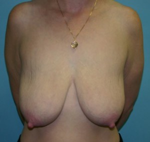 Before Breast Lift Surgery