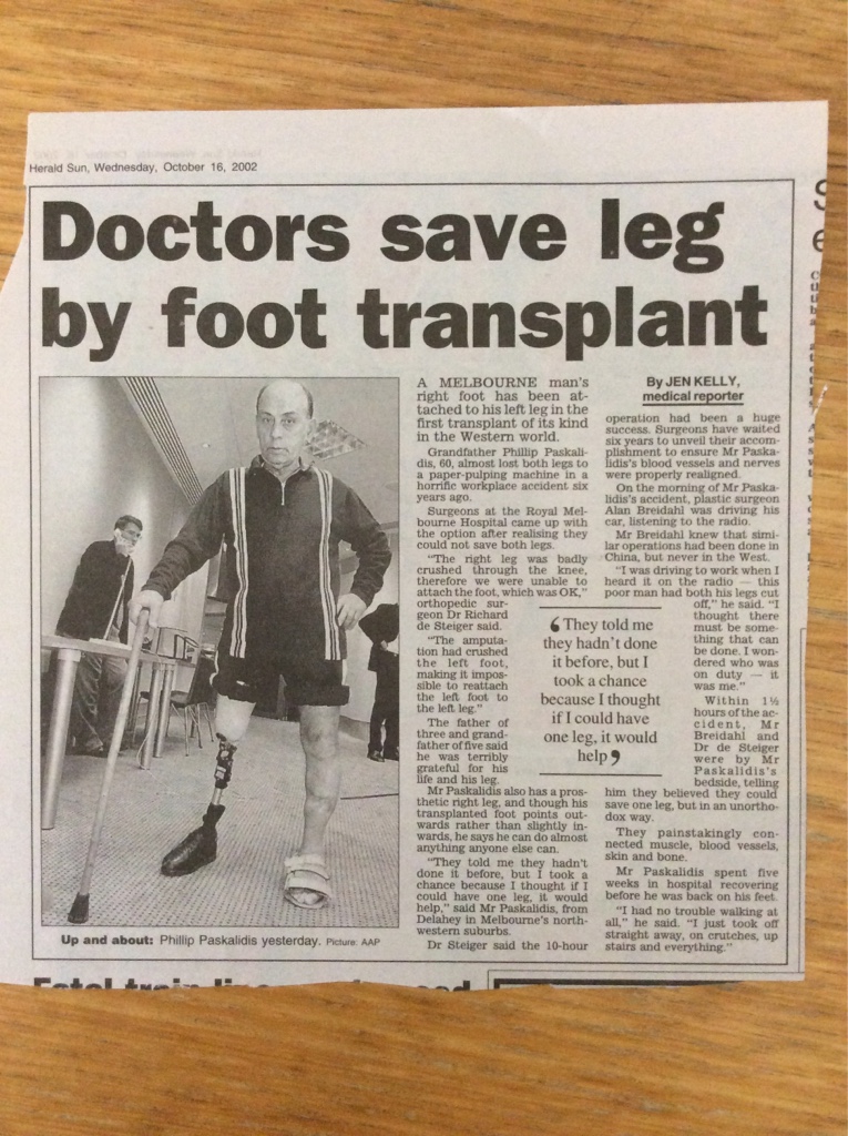Doctors save leg by foot transplant