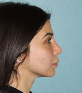 Rhinoplasty (Nose) Before & After