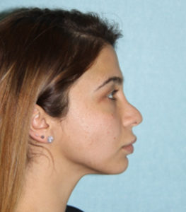 Surgery of the nose