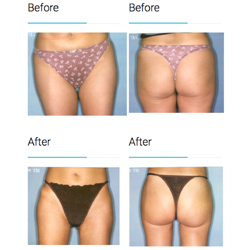 Surgical Liposuction But