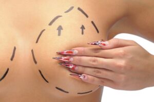Breast Surgery Melbourne